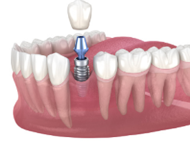 Yes Dentistry dental implants Adelaide